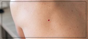 Cherry Angioma Removal Treatment Near Me In Northridge, Los Angeles, CA Cherry Angioma Removal Treatment Near Me In Northridge, Los Angeles, CA