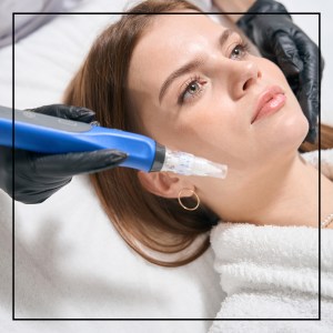 SkinPen Microneedling in Northridge, Los Angeles, CA