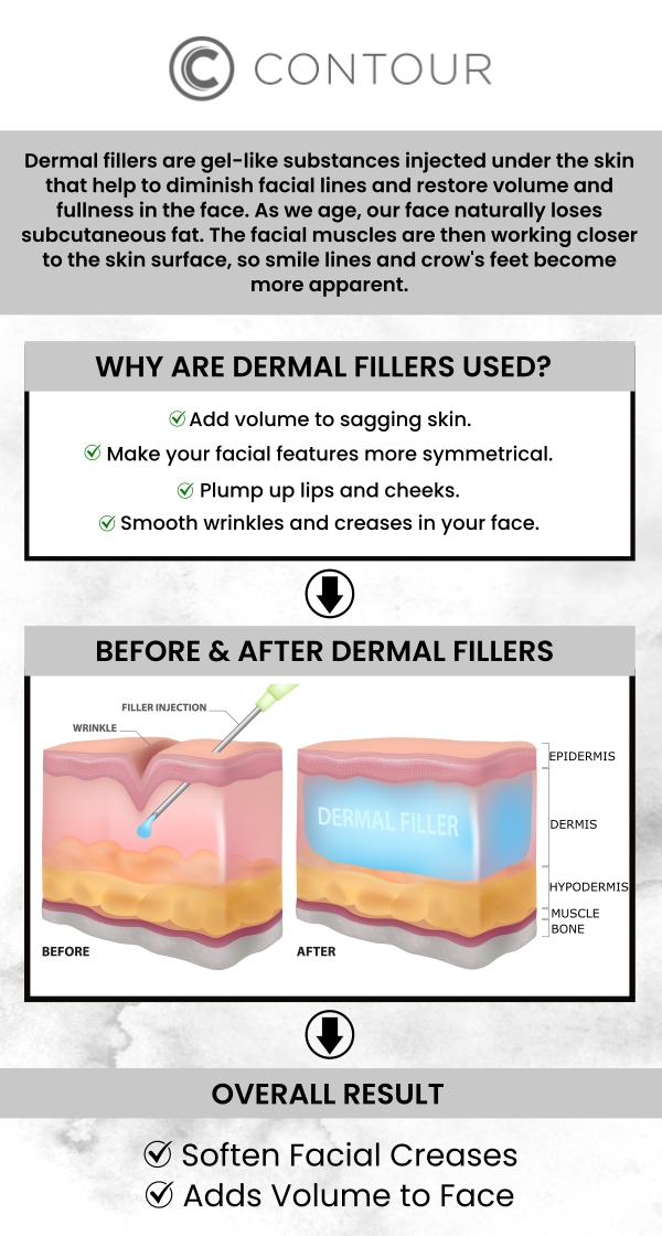 Dermal fillers are used to treat fine lines and deep wrinkles, lessen scars and skin depression, and minimize the effects of aging. Our experienced team at Contour Medical Spa offers dermal fillers (Juvederm), a non-surgical, safe, and effective method to restore a more youthful and revitalized appearance. For more information, contact us or book an appointment online. We are conveniently located at 18641 Devonshire Street Northridge, CA 91324.