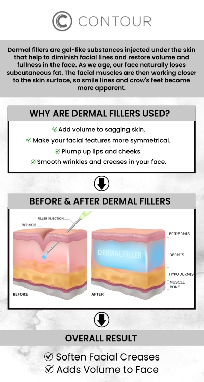 Dermal fillers are used to treat fine lines and deep wrinkles, lessen scars and skin depression, and minimize the effects of aging. Our experienced team at Contour Medical Spa offers dermal fillers (Juvederm), a non-surgical, safe, and effective method to restore a more youthful and revitalized appearance. For more information, contact us or book an appointment online. We are conveniently located at 18641 Devonshire Street Northridge, CA 91324.