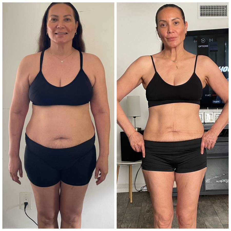 Before & After photos of Weight Loss GLP in Northridge, Los Angeles, CA
